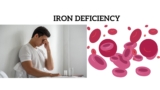 What are the 3 stages of iron deficiency?